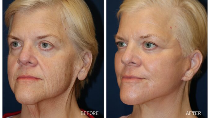 Laser Before and After